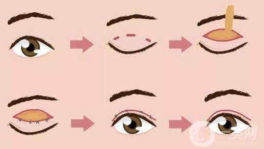 北京埋線雙眼皮修復(fù)價(jià)格盤點(diǎn)