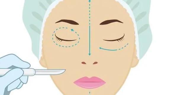 *開(kāi)眼角,*開(kāi)眼角價(jià)位