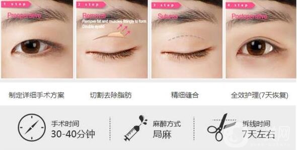 西安丁醫(yī)生*開眼角,*開眼角