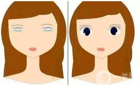 上瞼下垂矯治術(shù)*果怎么做 保持多久？