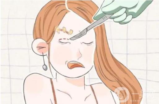 開(kāi)眼角手術(shù)前后圖 開(kāi)眼角注意事項(xiàng)