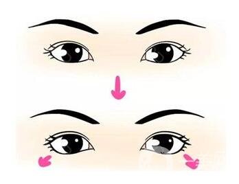 開外眼角前后 開外眼角手術*果怎么樣？