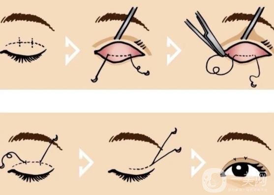 南醫(yī)大二附院割雙眼皮多少錢？整形價格表及術后*果圖一覽