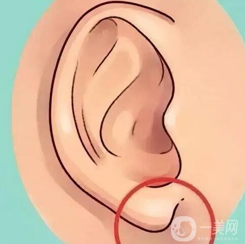 玻尿酸注射豐耳垂要注意什么？術(shù)后護(hù)理詳細(xì)介紹