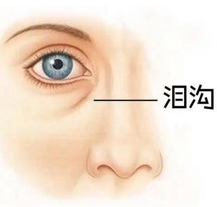 玻尿酸填充淚溝維持時間,玻尿酸填充淚溝