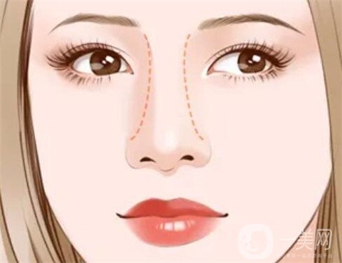 玻尿酸隆鼻恢復(fù)時間 用玻尿酸隆鼻好嗎