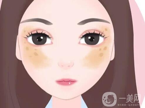 牛奶咖啡斑如何調(diào)節(jié) 咖啡斑的調(diào)節(jié)方法有哪些