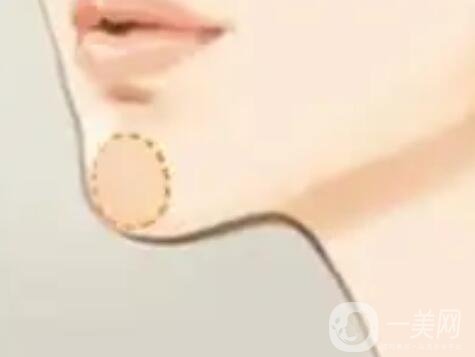 廣東雙下巴吸脂價(jià)格