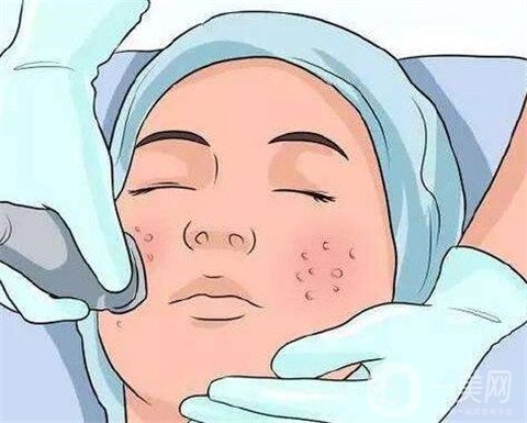 激光祛痘注意事項有哪些？