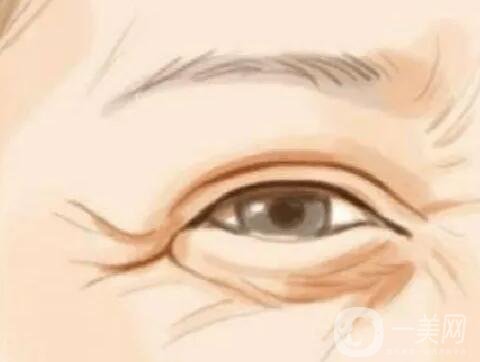 去除魚尾紋方法有哪些 注射玻尿酸*果好嗎？