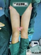 自從在醫(yī)院做了大腿吸脂手術(shù)以后，我終于擁有了兩條纖細(xì)筆直的漫畫(huà)腿