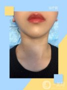 打完嗨體已經(jīng)有一周的時間了，現(xiàn)在脖子上面的紅腫已經(jīng)完全不見了