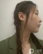 剛做完拉皮的這幾天真的是特別的不適應(yīng)，因?yàn)槊刻於加性诖黝^套