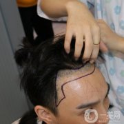 在朋友推薦之下，我終究還是做了植發(fā)手術(shù)，經(jīng)過(guò)長(zhǎng)期以來(lái)的生長(zhǎng)