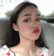 時(shí)間過得還真是快呀，我已經(jīng)熬過了前兩周，現(xiàn)如今植發(fā)的部位有一些癢