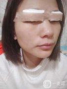 心心念念的雙眼皮終于是做完了，對(duì)自己的雙眼皮一直以來(lái)都是特別的不滿意