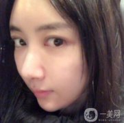 做完面部填充手術(shù)已經(jīng)半年的時(shí)間了，現(xiàn)在我的臉部脂肪已經(jīng)穩(wěn)定下來(lái)了