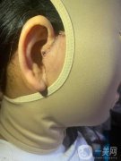 做拉皮手術的這件事情，也是經(jīng)過我深思熟慮的，我去了三家醫(yī)院進行了面診