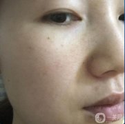 做完皮秒祛斑已經(jīng)是第15天了，做這個皮秒之前，會給你打麻藥，不用擔(dān)心疼