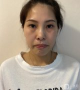 做完皮秒，我的臉白得像個(gè)帶殼的雞蛋，激動(dòng)~