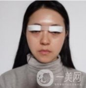 我來(lái)了，我來(lái)了，做的眼綜合，半個(gè)月才拆線 效果很好