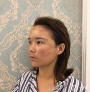 今天是第十五天，真的沒想到用脂肪填臉的效果這么好