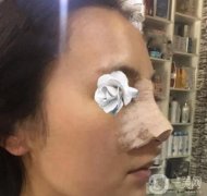 時間過得真快，做完隆鼻已經(jīng)一周了