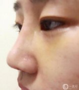 手術(shù)已經(jīng)半個月了，整體感覺還不錯，沒有異物感