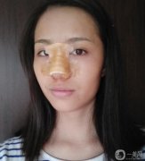 鼻子還在恢復(fù)中,還是有點(diǎn)硬，手感還沒有達(dá)到自然