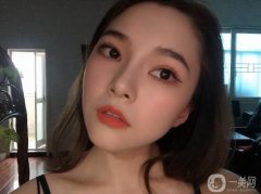 滿(mǎn)月打卡!30天恢復(fù)，鼻子還是很好的，鼻型和鼻腔的切口都很好，沒(méi)有異常不適