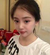 拆線后拍了照，鼻子還是有點(diǎn)腫，但是鼻子的形狀自然多了