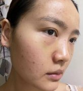 術(shù)后第四天，鼻子形狀很美