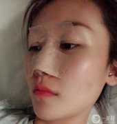 鼻部修復(fù)第7天醫(yī)生說(shuō)我恢復(fù)的很好,越來(lái)越羨慕自己，不知道當(dāng)初的勇氣是從哪