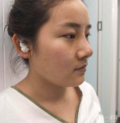 經(jīng)過一番思考，我終于決定做鼻子整形手術