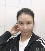 減脂很難，也瘦不了多少，所以面部吸脂真的幫了我很多