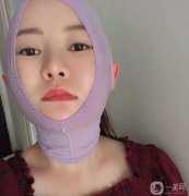 我在下部做了吸臉和線雕，解決了臉上脂肪厚度和皮脂下垂的問題