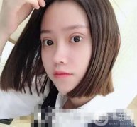 做完眼綜合手術(shù)已經(jīng)有二十多天的時間了，眼睛消腫得越來越快了