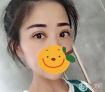 做雙眼皮手術(shù)的想法在我腦海里已經(jīng)存在很久了