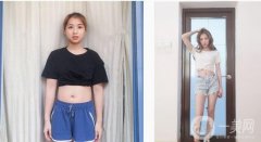 腰腹吸脂術(shù)后一個(gè)月，經(jīng)過一個(gè)月的修復(fù)，越來越漂亮，身體也越來越苗條