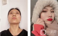 當(dāng)我做完眼部手術(shù)后，我會在打洗臉，而不是像往常一樣