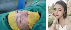 隆鼻、面部填充已經(jīng)快一個月了，現(xiàn)在鼻子恢復(fù)情況比前兩周好了很多