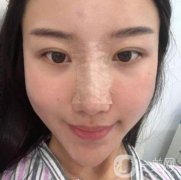 這個丑鼻子降低了我的面值，我想做手術(shù)