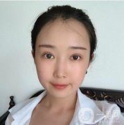 不得不說雙眼皮的變化還是很大的