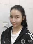 我早就想做面部吸脂了，我去過很多家，也咨詢過醫(yī)院