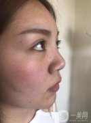 現(xiàn)在我的鼻子很豎立，鼻梁的位置比以前窄了很多