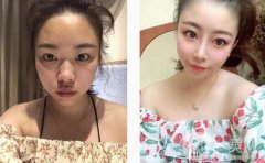 醫(yī)生說我的鼻子需要抬高鼻梁，然后縮小鼻子