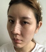 在網(wǎng)上查了很多隆鼻的資料，看到了各種鼻子類型