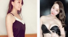 假體隆胸后一個(gè)月，現(xiàn)在有了漂亮性感的乳房，穿性感吊帶就沒壓力了