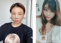 隆鼻第一天，迫不及待的想和大家分享