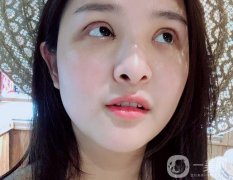 一定要特別注意雙眼皮的恢復期，說怎么剪雙眼皮的睫毛，怎么讓睫毛更長更密